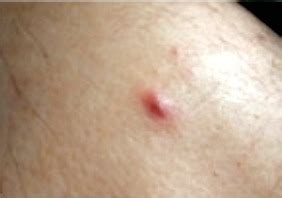 Abscess skin boils – Types of Boils, Causes, and Cures