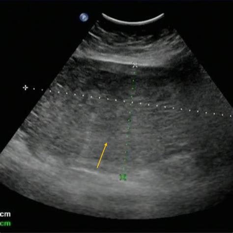 All six published cases of giant hydatidiform mole in postmenopausal ...