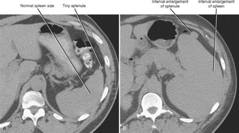 Spleen | Radiology Key