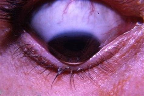 Keratoconus : Symptoms, Causes and Treatment - Netralaya