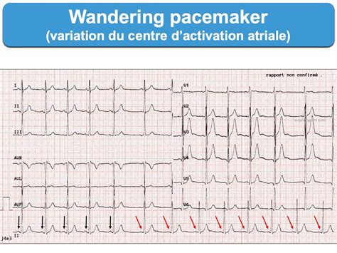 Wandering pacemaker (WPM) : e-cardiogram