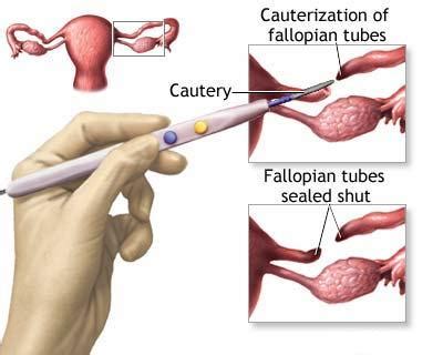 Cost and Success Rates of Tubal reversal and in Vitro Fertilization Surgery