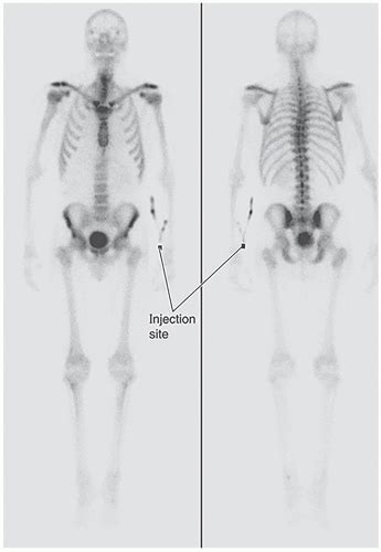 Bone Scintigraphy | Radiology Key