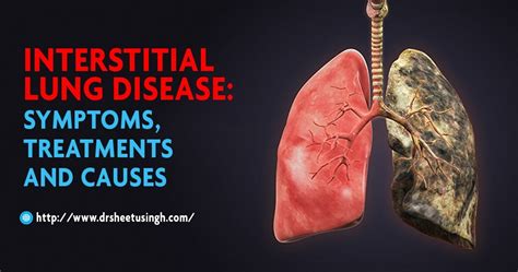 Interstitial Lung Disease: Symptoms, Treatments and Causes | Dr Sheetu