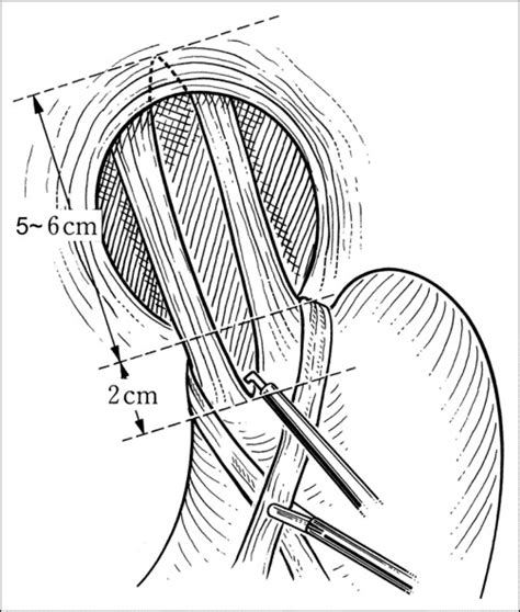 Laparoscopic Heller myotomy with Toupet fundoplication for achalasia ...