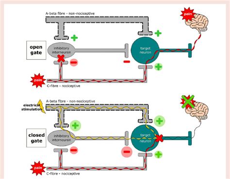 'Open' and 'closed' gate in accordance with the gate control theory of... | Download Scientific ...