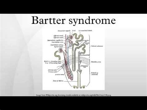 Bartter syndrome