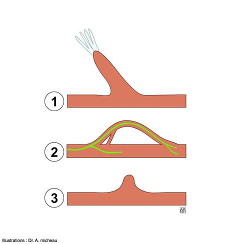 Trabeculae carneae - e-Anatomy - IMAIOS