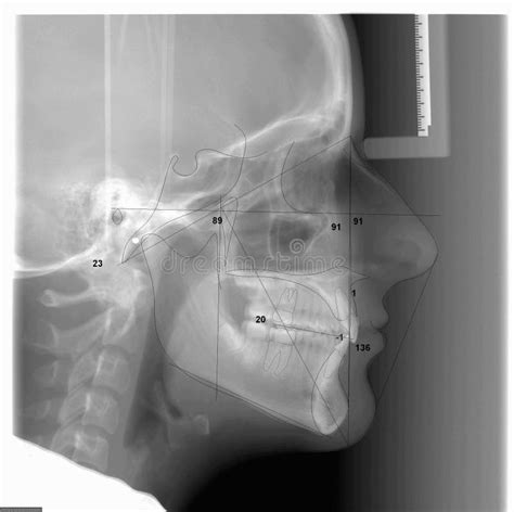 A Traced Cephalometric X-ray Stock Photo - Image: 7046610