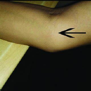 Swelling at medial side of the left elbow joint. | Download Scientific Diagram