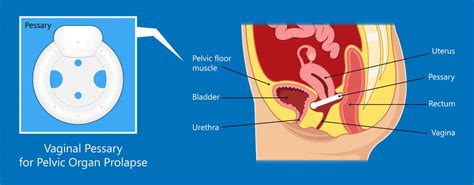 Using a Pessary for Symptoms of Prolapse