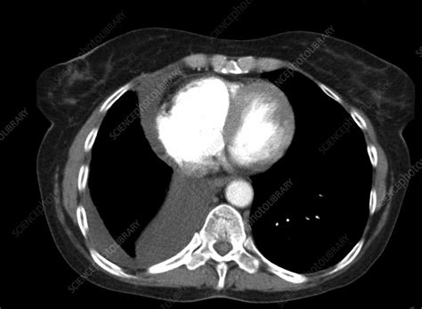 Pleural effusion, CT scan - Stock Image - C036/6430 - Science Photo Library