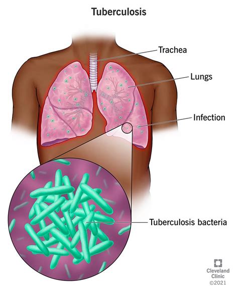 Tuberculosis: Causes, Symptoms, Diagnosis & Treatment