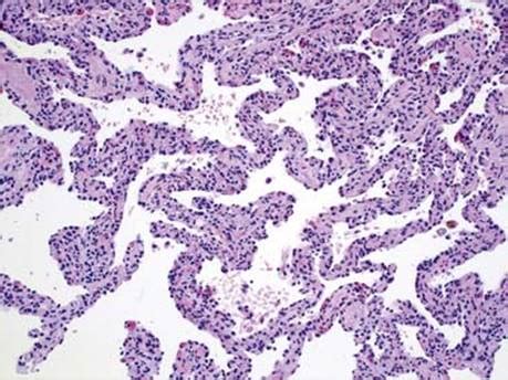 Interstitial Pneumonia Histology