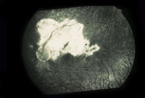 Paracentral Blind Spot And Scotoma - Retina Image Bank