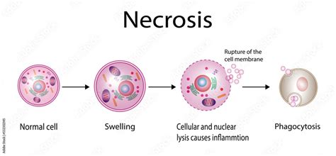 Necrosis, Pathologic Cell Death, Death of the body tissues, Cell injury which results in the ...