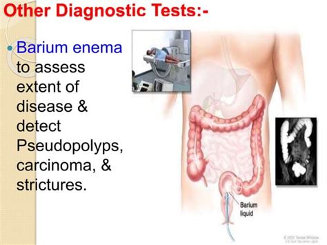 Ulcerative Colitis