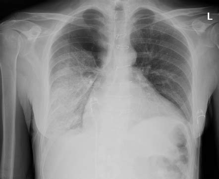 Re-expansion pulmonary edema | Radiology Case | Radiopaedia.org