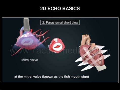 2d Echo Basics