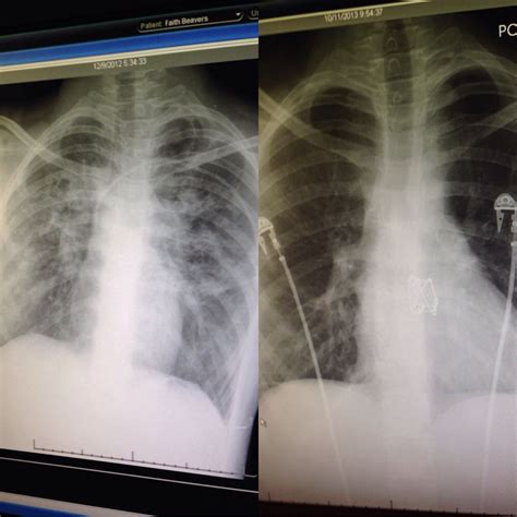 My lungs before and after my double lung transplant (left is severely damaged cystic fibrosis ...