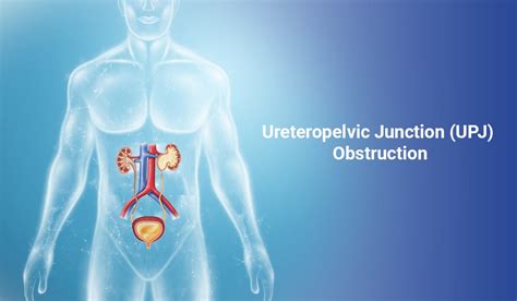 An Overview of Ureteropelvic Junction (UPJ) Obstruction | by Saketnarnoliurologist | Medium