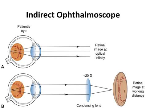 Binocular Indirect Ophthalmoscopy The Beginner's Guide, 44% OFF