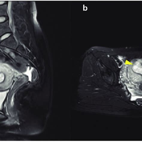 Laparotomic view of our case of myomectomy scar pregnancy. (a) Bulging ...