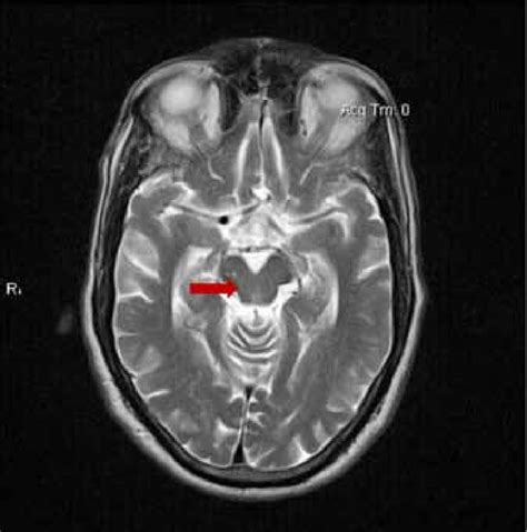 Psp Mri Brain