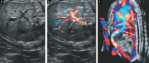 Portal Vein Portal Ultrasound Anatomy | SexiezPicz Web Porn