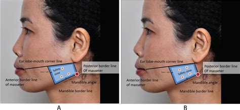 Masseter Hypertrophy: Toxin Treatment Techniques, Causes of ...