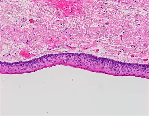 Odontogenic keratocyst | Global Pathology Teaching and Education Program