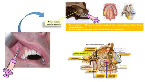Bloqueo Del Nervio Infraorbitario