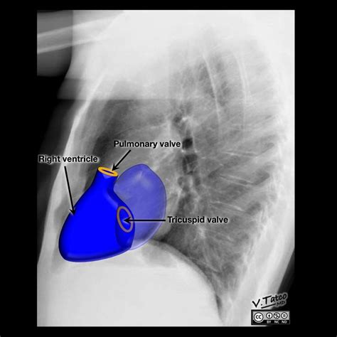 Cardiomediastinal anatomy on chest radiograph | Radiology Case ...