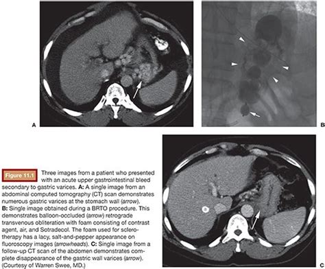 Sclerosing Agents | Radiology Key