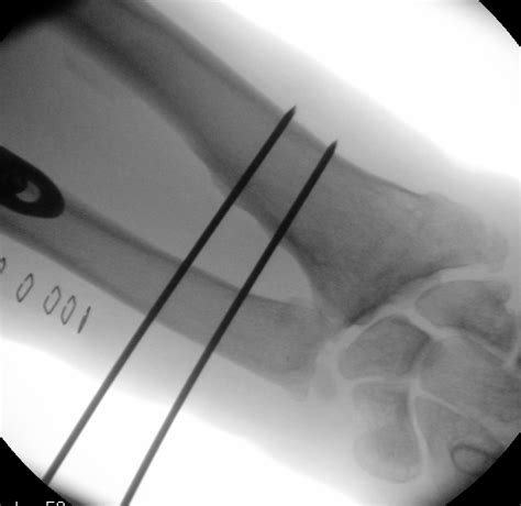 Essex-Lopresti fracture-dislocation