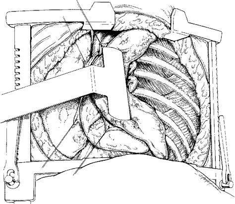 Figure 1 from The clamshell incision for bilateral pulmonary artery ...