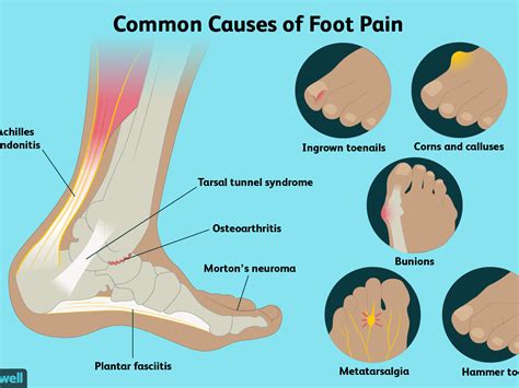 Diagnosing Foot Pain Diagram