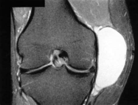 Ppt Ultrasound Case Meniscal Tear With Cyst Formation - vrogue.co