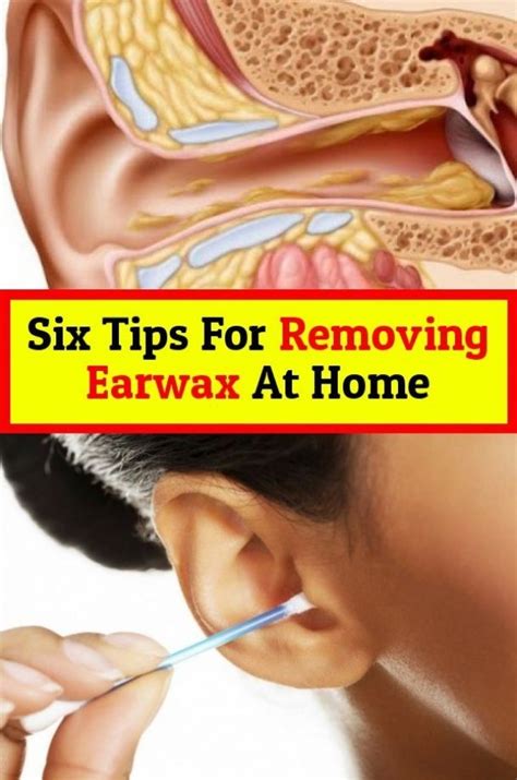 Here are six tips to remove Earwax in 2020 | Ear wax, Natural lubricant, Ear wax removal