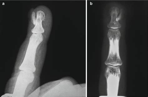 Subungual Exostosis | Musculoskeletal Key