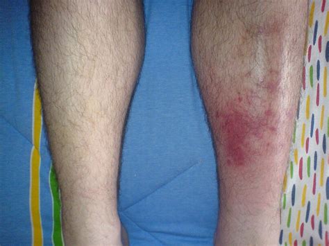 File:Cellulitis1.jpg - Wikipedia