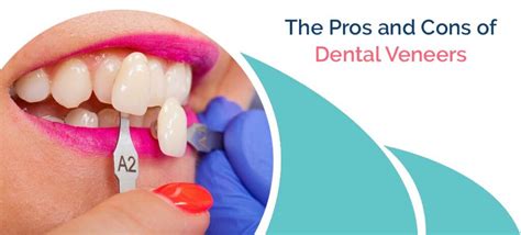 The Pros and Cons of Dental Veneers - ContentViral.com