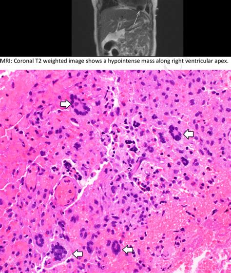 An area of tumour shows several multinucleated Touton giant cells in a... | Download Scientific ...