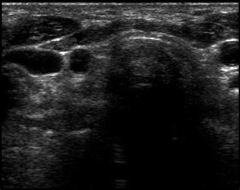 The Role of Ultrasound in the Differential Diagnosis of Hypothyroidism ...