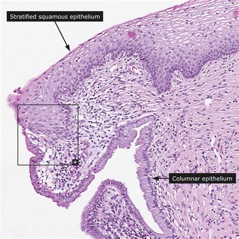 normal transformation zone histology cervix | Cervix, Reproductive system, Histology slides