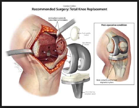 Get a knee replacement in Mexico and save enough money to live on for a ...