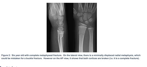 Buckle (Greenstick) Fracture of the Distal Radius - Sports Medicine Review