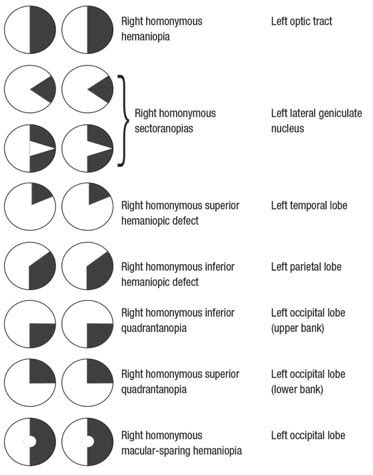 Neurological Visual Field Defect