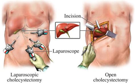 Open Cholecystectomy Surgery for Gallstones | Benefits & The Process