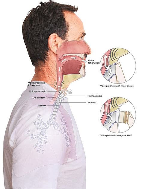 Voice rehabilitation with voice prosthesis | Fahl